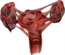 endometriosis1